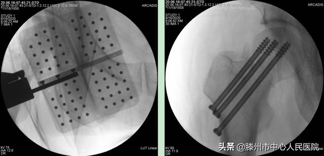 滕州市中心人民医院成功完成骨科机器人手术