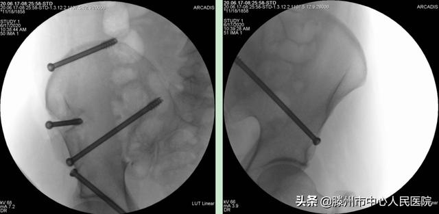 滕州市中心人民医院成功完成骨科机器人手术