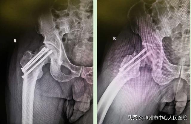 滕州市中心人民医院成功完成骨科机器人手术