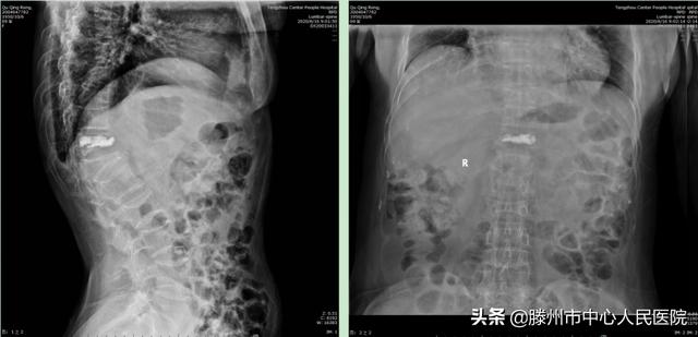 滕州市中心人民医院成功完成骨科机器人手术