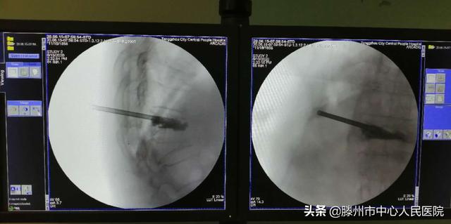 滕州市中心人民医院成功完成骨科机器人手术