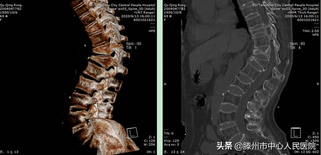 滕州市中心人民医院成功完成骨科机器人手术