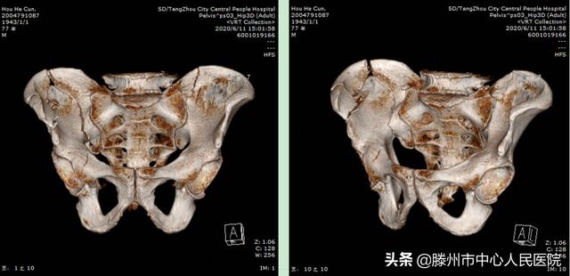 滕州市中心人民医院成功完成骨科机器人手术